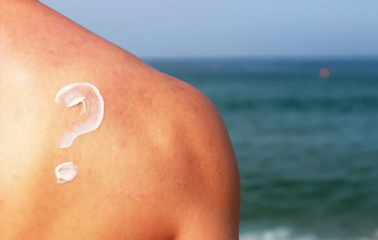 cbd balm for sunburn